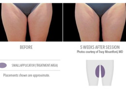 Coolsculpting Non-Surgical Fat Removal