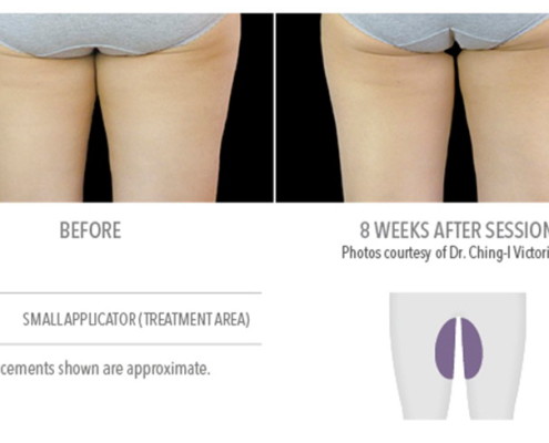Coolsculpting Non-Surgical Fat Removal