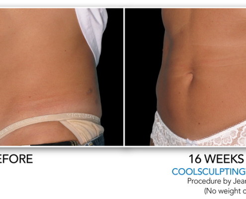 Coolsculpting Non-Surgical Fat Removal