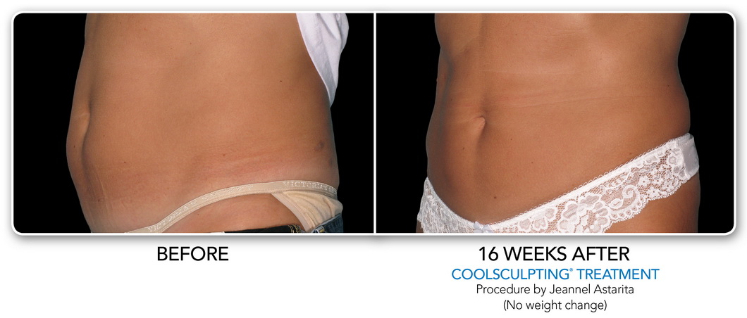 Coolsculpting Non-Surgical Fat Removal