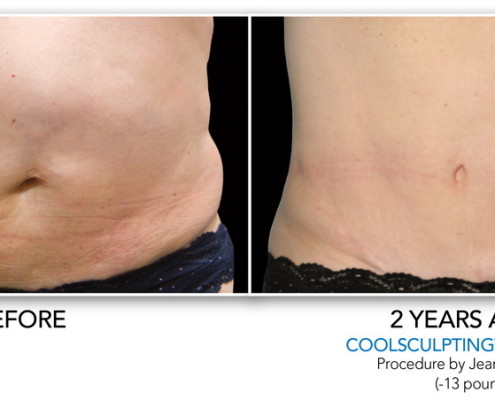 Coolsculpting Non-Surgical Fat Removal