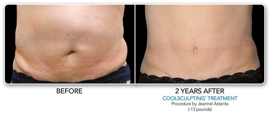 Coolsculpting Non-Surgical Fat Removal