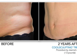 Coolsculpting Non-Surgical Fat Removal