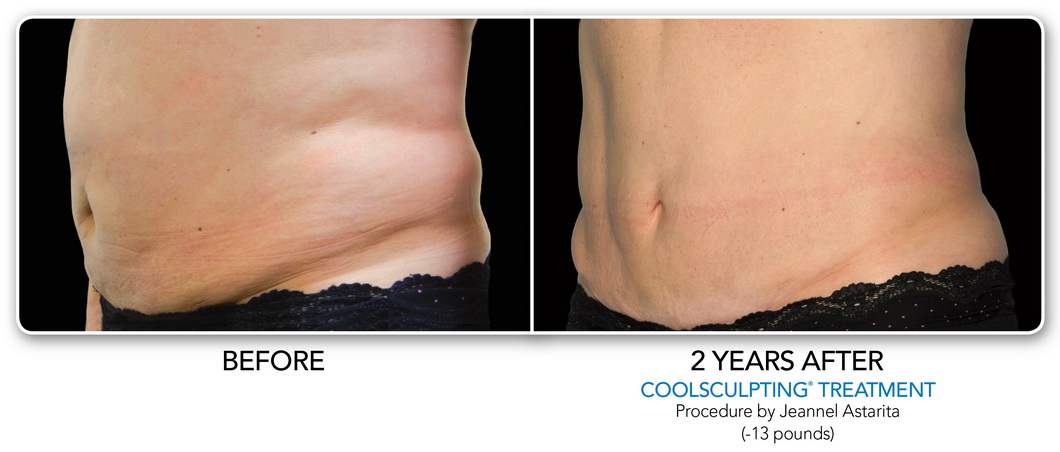 Coolsculpting Non-Surgical Fat Removal