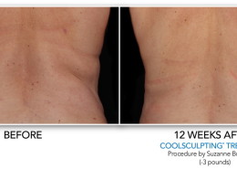 Coolsculpting Non-Surgical Fat Removal