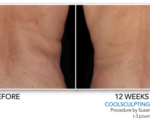 Coolsculpting Non-Surgical Fat Removal