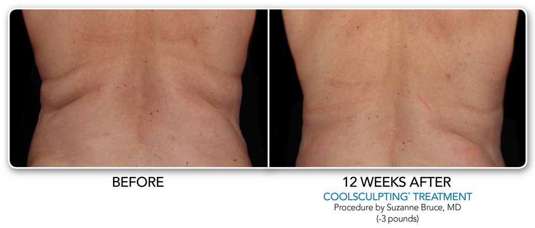 Coolsculpting Non-Surgical Fat Removal