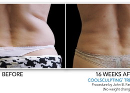 Coolsculpting Non-Surgical Fat Removal