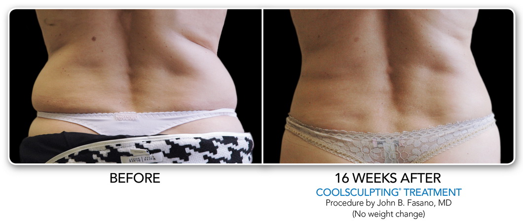 Coolsculpting Non-Surgical Fat Removal