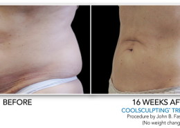 Coolsculpting Non-Surgical Fat Removal