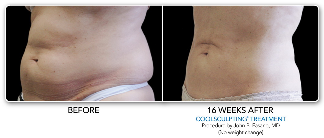 Coolsculpting Non-Surgical Fat Removal