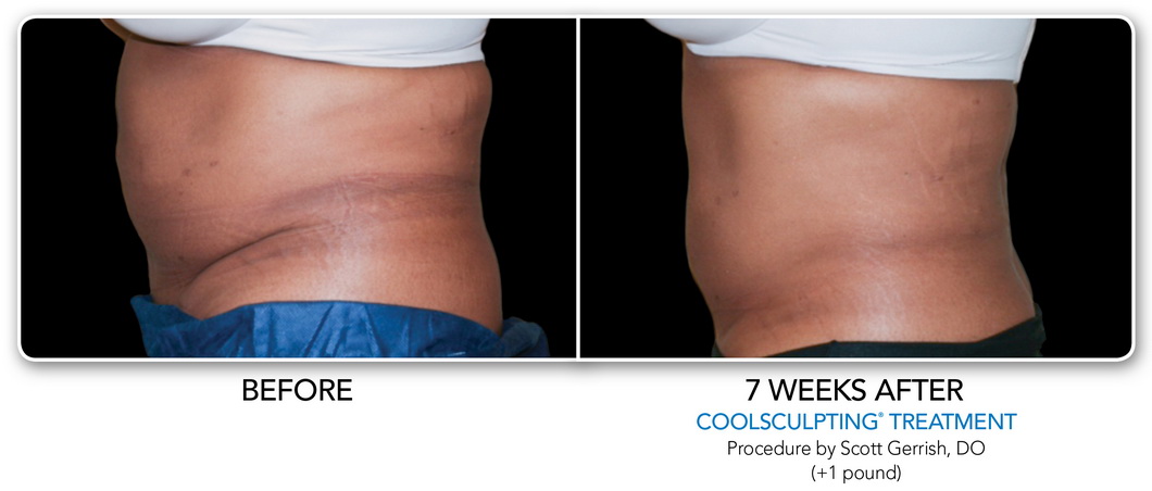 Coolsculpting Non-Surgical Fat Removal