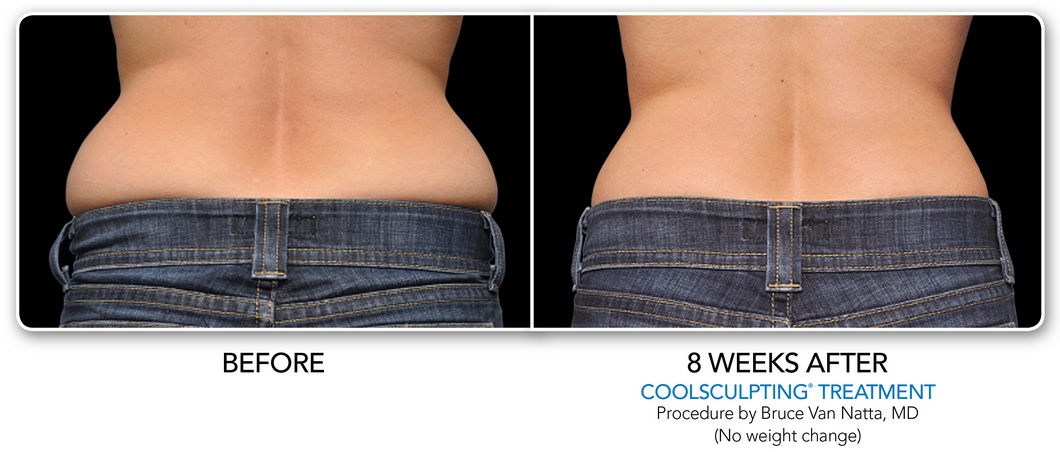 Coolsculpting Non-Surgical Fat Removal