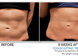 Coolsculpting Non-Surgical Fat Removal