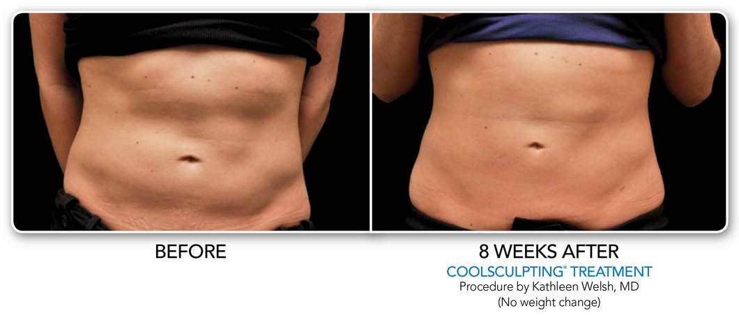 Coolsculpting Non-Surgical Fat Removal