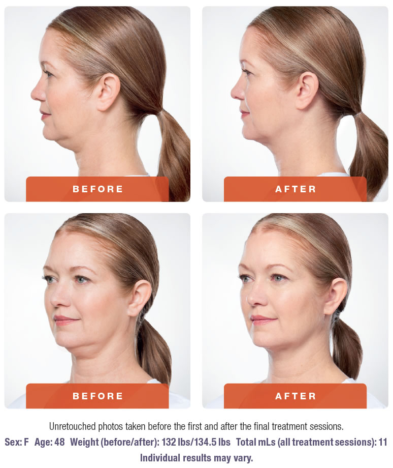 KYBELLA® Double Chin Treatment, Long Beach, Orange County