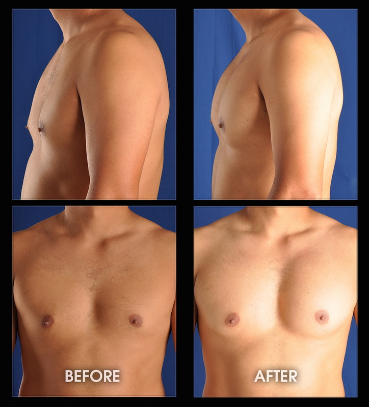 Pectoral Implants - Pecs, Male Chest Reconstruction, Male Plastic Surgery