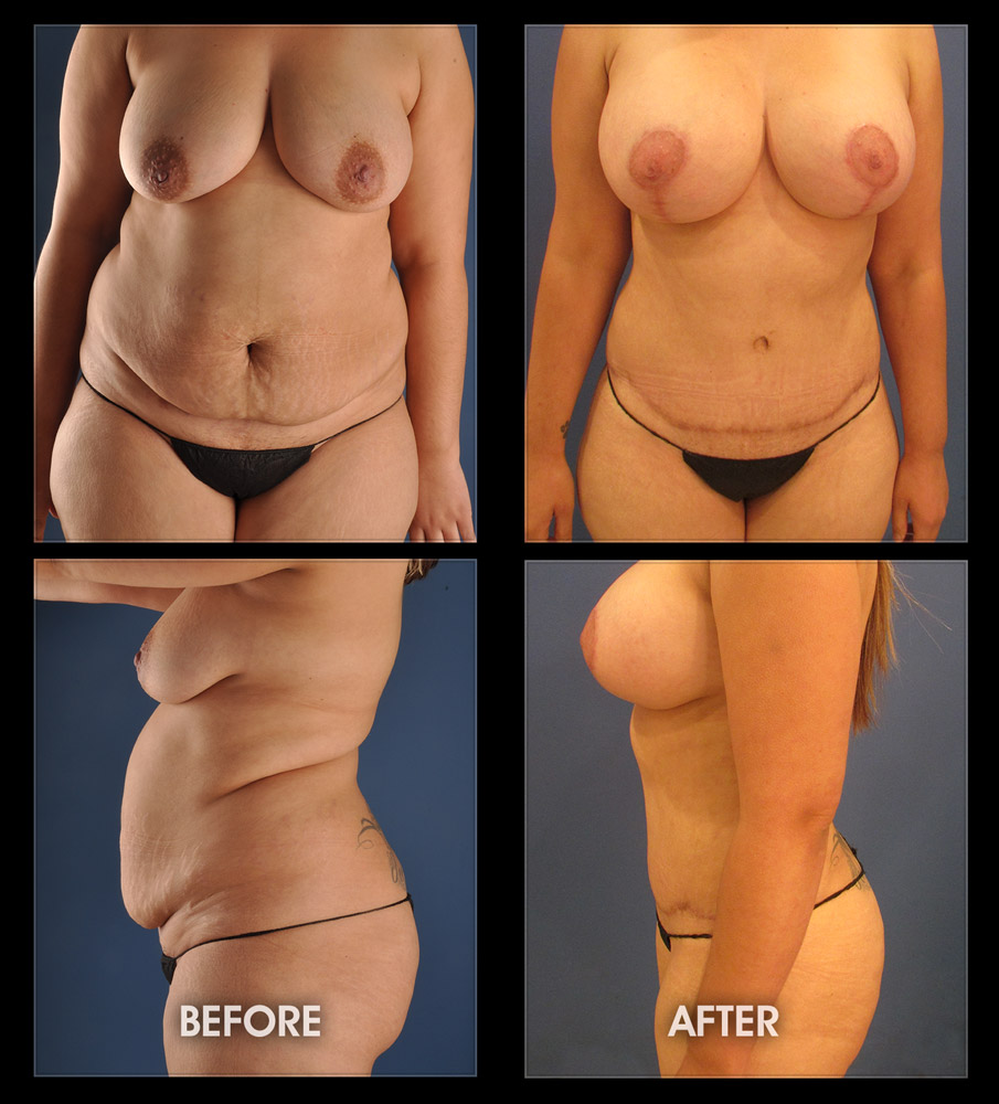 Tummy Tuck