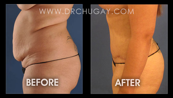 Tummy Tuck Surgery - Abdominoplasty, Long Beach, Orange County