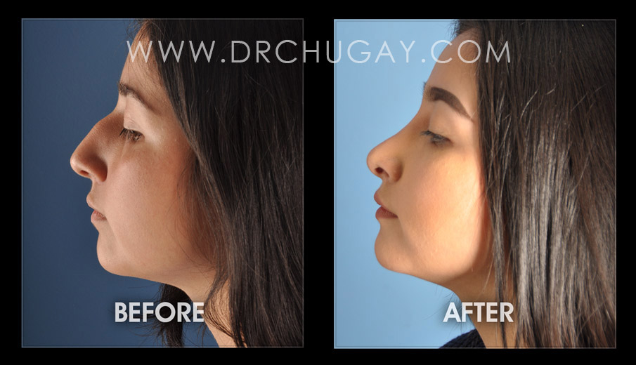 Best Rhinoplasty Surgeon - Find A Top Surgeon for a Nose Job - Dr Adam  Basner