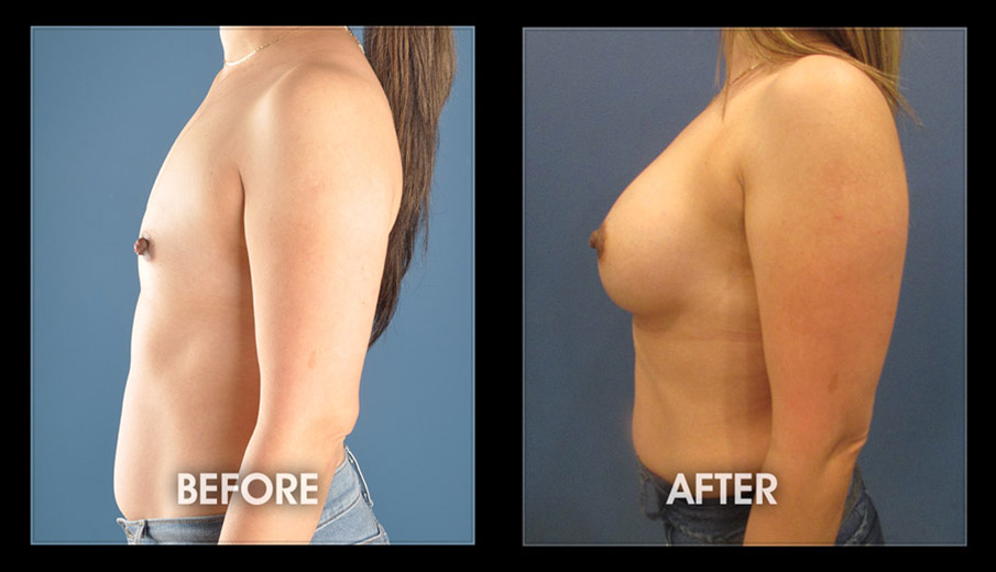 Breast Implant Surgery - Augmentation, Long Beach, Orange County