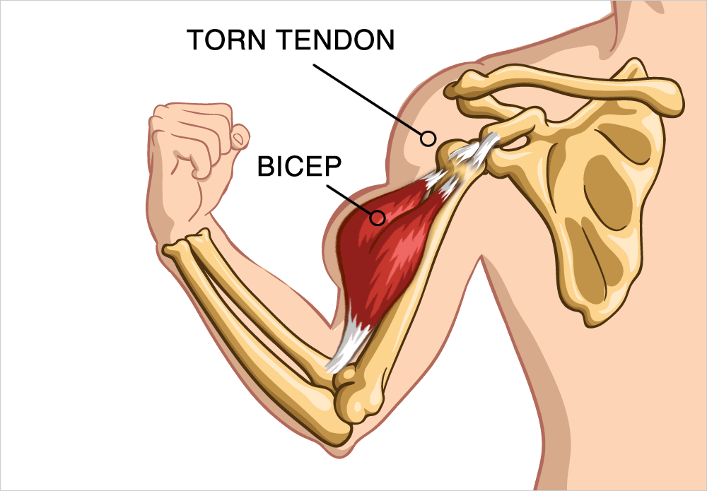 Popeye Arm Deformity