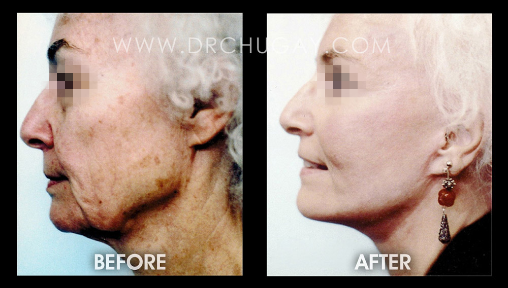 Vertical Facelift | Before and After | Surgical Procedures | Beverly Hills | CA