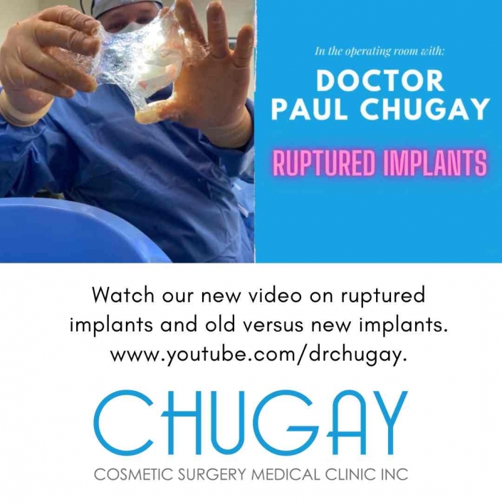 icd 10 code for ruptured silicone breast implants
