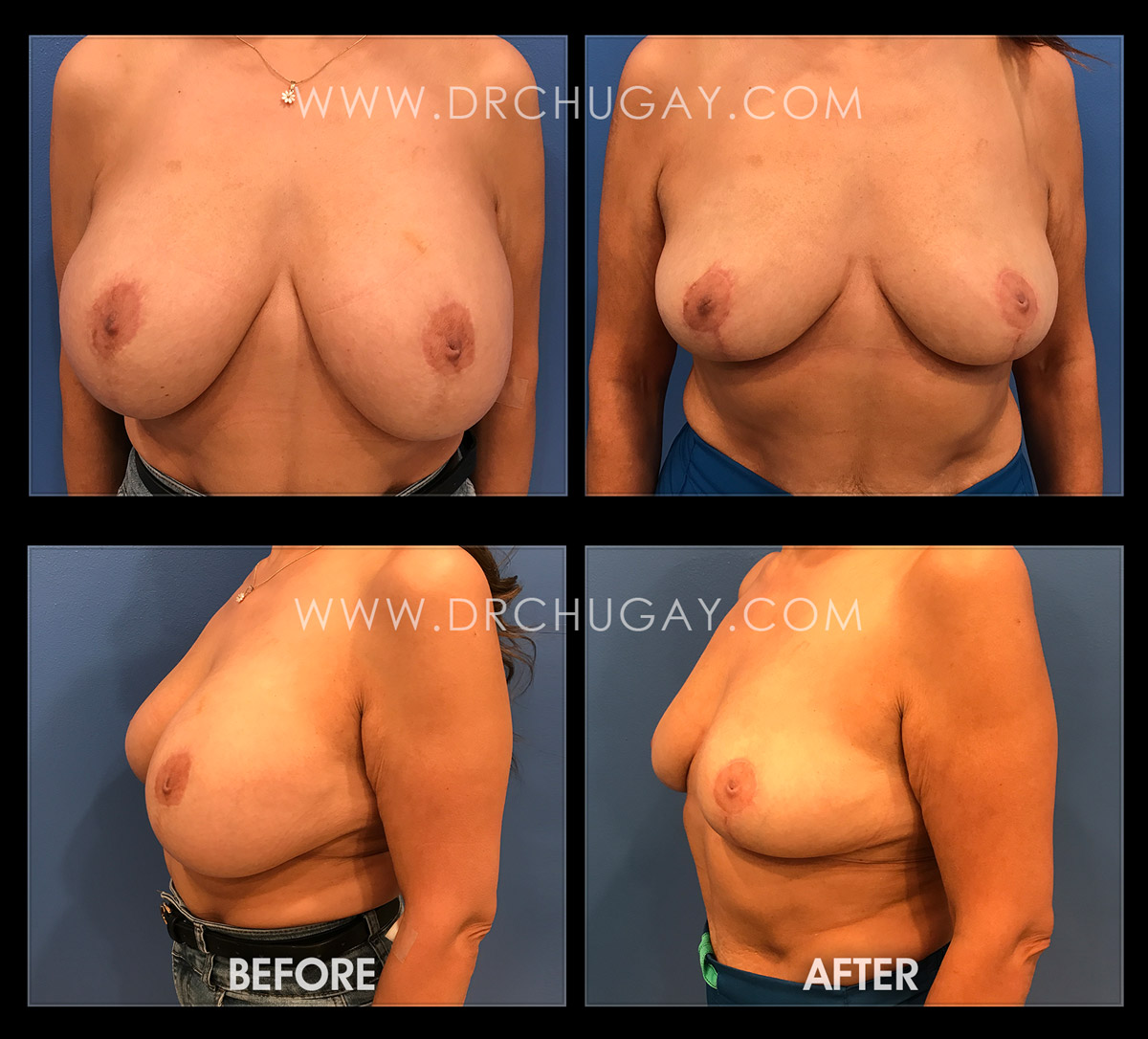 59yo breast implant removal and breast lift Breast implant removal with breast lift