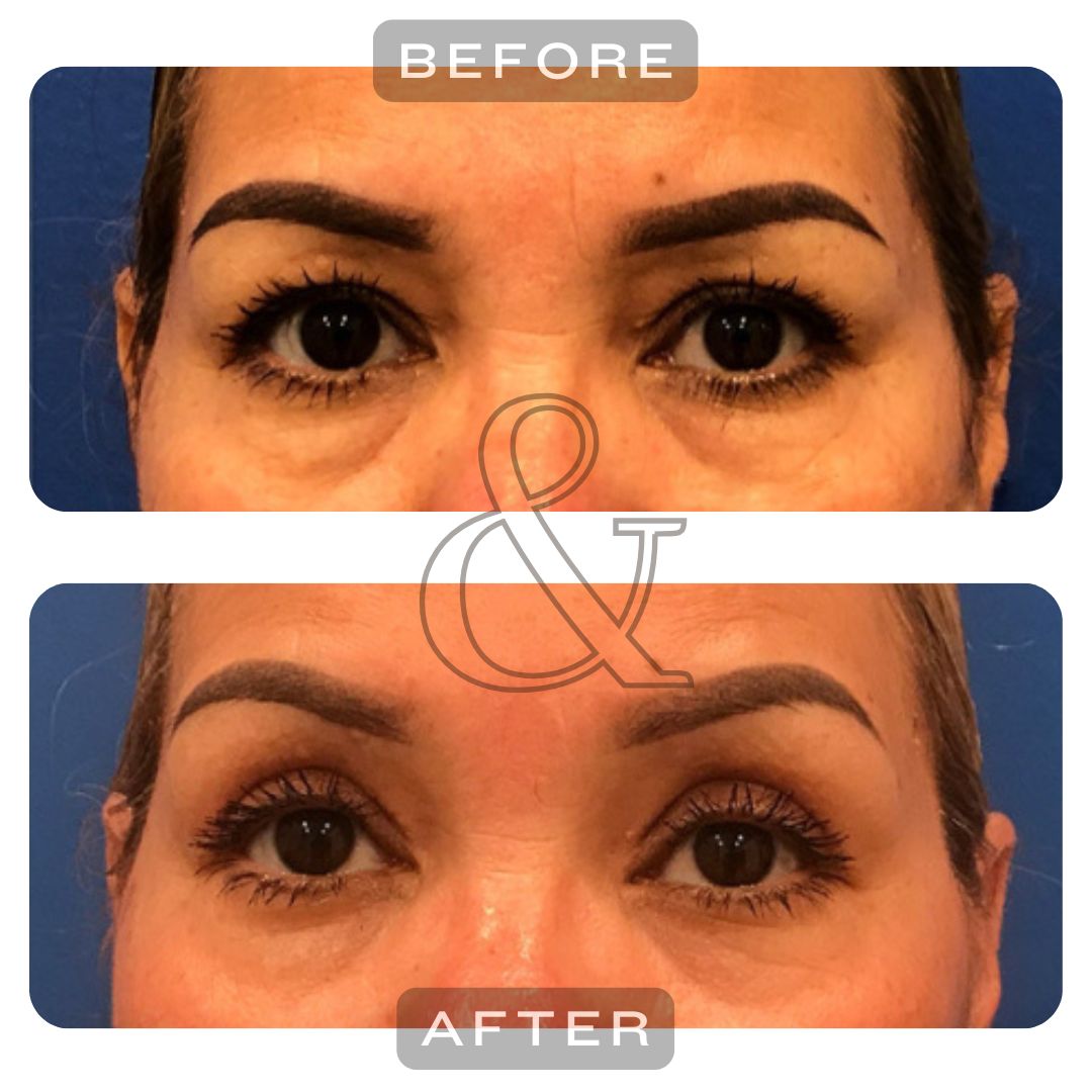 eyelids before-after
